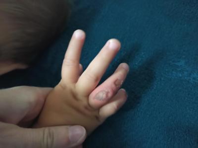 Úrazy a pády | Hojení stržené kůže