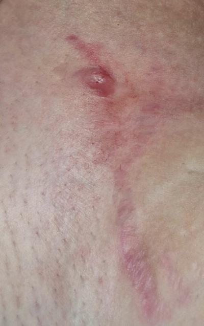 Alergie a ekzémy | Hrčka pod semenníkom