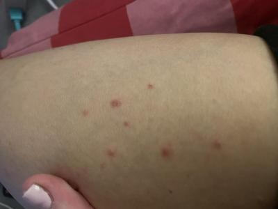 Alergie a ekzémy | Vyrážka - co by to mohli být?