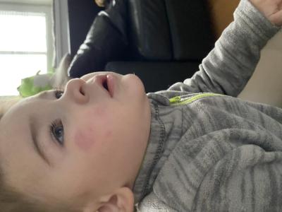 Alergie a ekzémy | Mizící pupínky