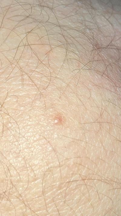 Alergie a ekzémy | Zajímavá vyrážka na těle
