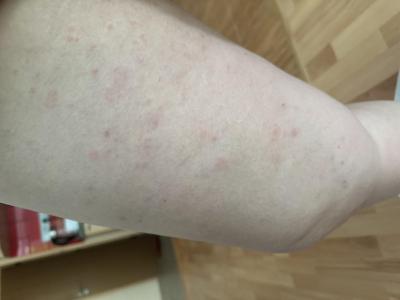 Alergie a ekzémy | Svrab, exem nebo vyrážka?