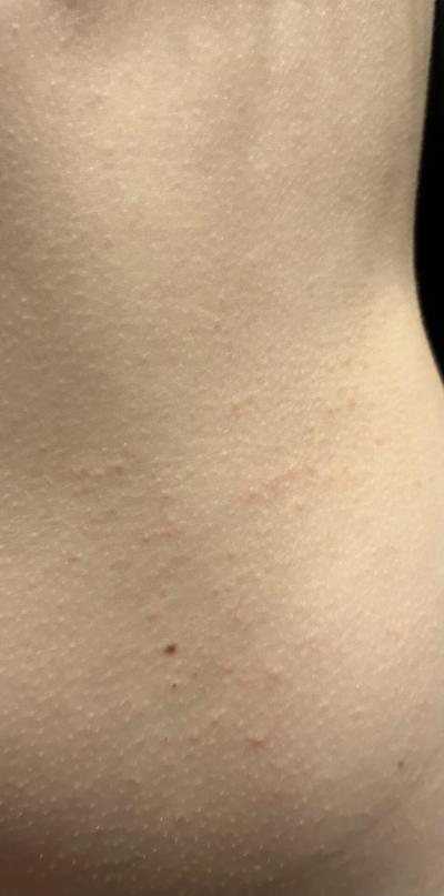 Alergie a ekzémy | Jedná se o svrab?