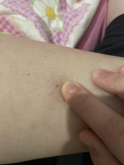Zdravotní potíže dospělých | Podrážděné znamínko