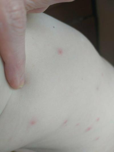 Zdravotní potíže dospělých | Stipnuti/alergie? Co myslite?