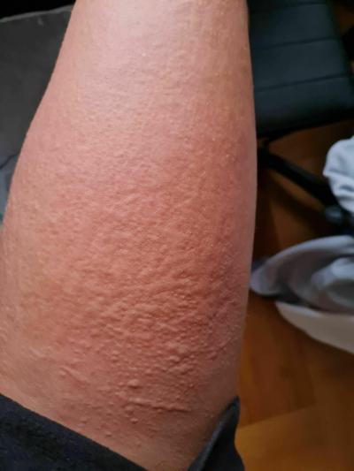Alergie a ekzémy | Mizejici vyrazka na těle