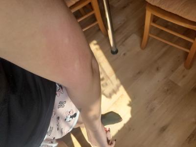Alergie a ekzémy | Pupínky po škrábání