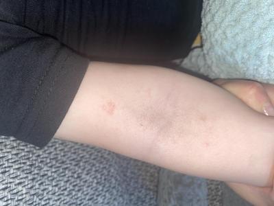 Lékaři, nemocnice a zdravotnická zařízení | Vyrážka na ruce tvrdší pupinky