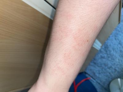 Alergie a ekzémy | Červené fleky po koupání