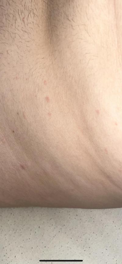 Zdravotní potíže dospělých | Je toto Pityriasis rosea