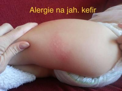 Alergie a ekzémy | Mizejici vyrazka na těle