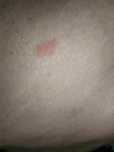 Alergie a ekzémy | Prosím, co to je za flek