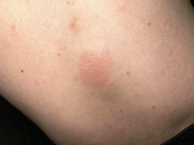 Alergie a ekzémy | Flek, ale původ nevím