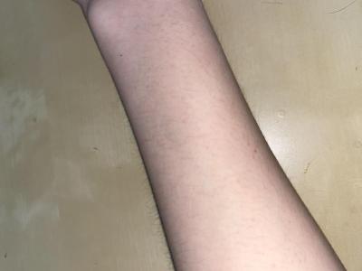 Alergie a ekzémy | Vyrážka po sprchování