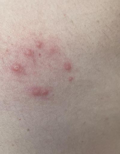 Alergie a ekzémy | Vyrážka - do práce nebo k Dr?