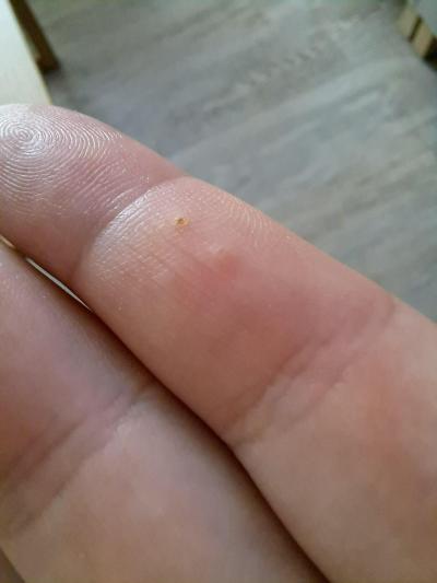 Zdravotní potíže dospělých | Pupínky na ruce