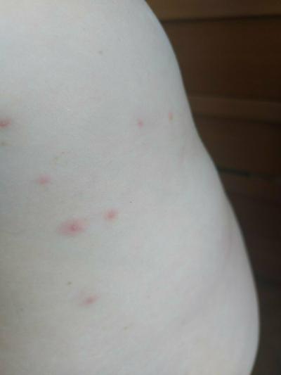 Zdravotní potíže dospělých | Stipnuti/alergie? Co myslite?