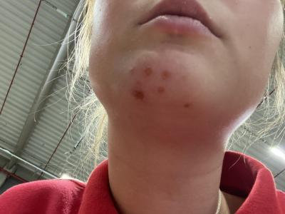 Alergie a ekzémy | “Vyrážka” na braděě