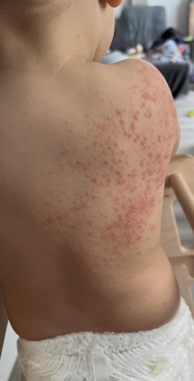 Dětské nemoci | Vyrážka / pupínky na chodidle