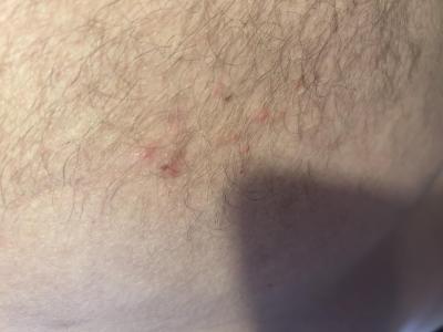 Zdravotní potíže dospělých | Pásový opar a vysoka horečka?