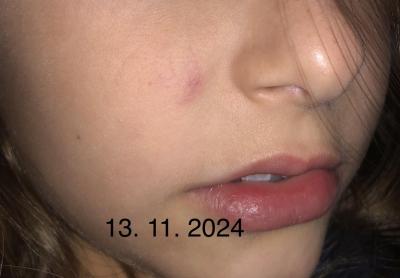 Dětské nemoci | Žilky v ohybu nosu u dítěte