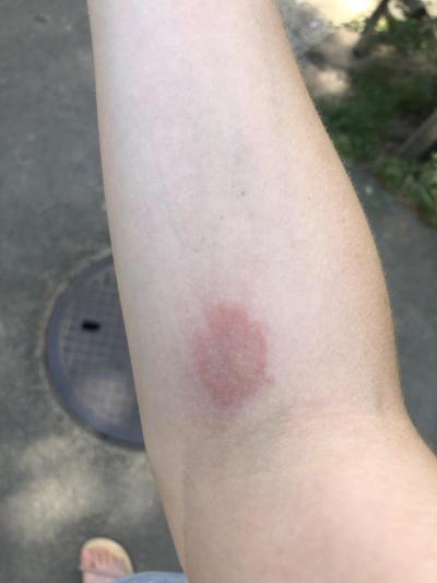 Zdravotní potíže dospělých | Kousnutí od komára a flek