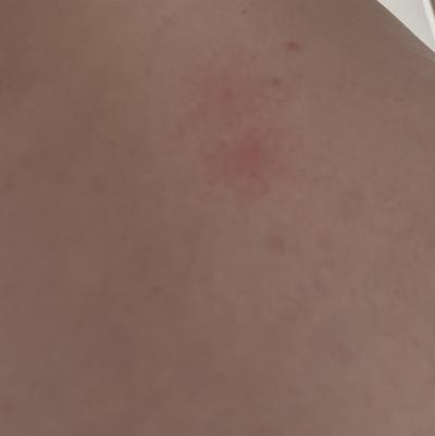 Alergie a ekzémy | Od čeho jsou tyhle štípance?