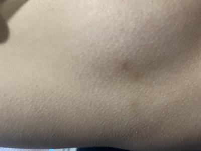 Zdravotní potíže dospělých | Hnědé flíčky v oblasti prsou/podpaží
