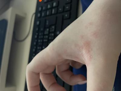 Alergie a ekzémy | Kožní vyrážka. Prosím nevíte?