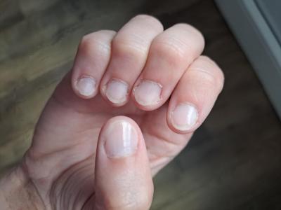 Kosmetika a hygienické potřeby | Co na ošklivé nehty?