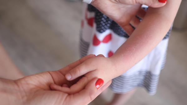 Jak rozeznat úžeh a úpal? Úžeh často provází spáleniny od slunce.