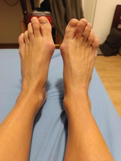 Zdravotní potíže dospělých | Operace MICA - hallux