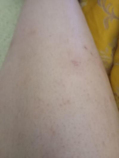 Zdravotní potíže dospělých | Štěnice, nebo blecha?