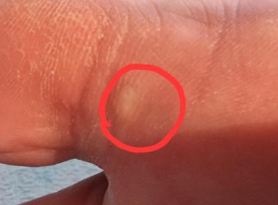 Zdravotní potíže dospělých | Otlak, kuří oko nebo co?