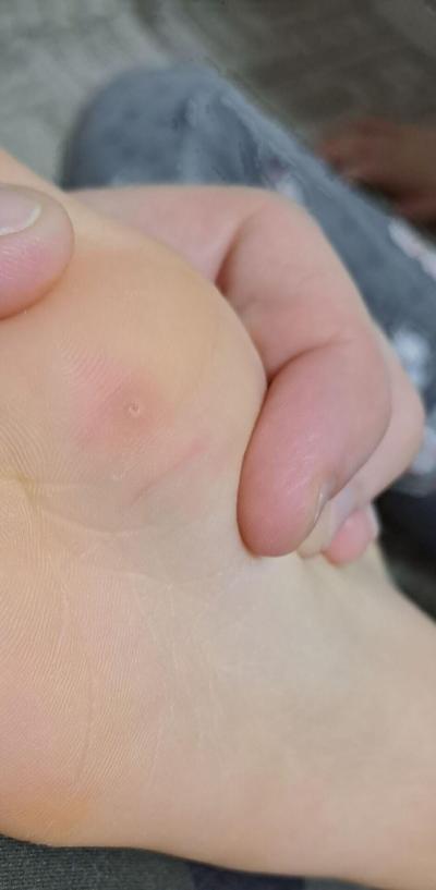 Dětské nemoci | Je tohle kuří oko? Dite