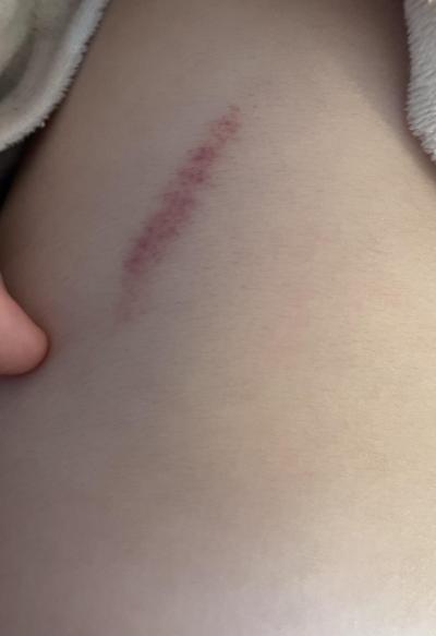 Dětské nemoci | Co je to? Petechie nebo jen šrám..
