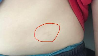 Dětské nemoci | Co su to za flaky na tele?