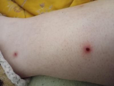 Zdravotní potíže dospělých | Štěnice, nebo blecha?