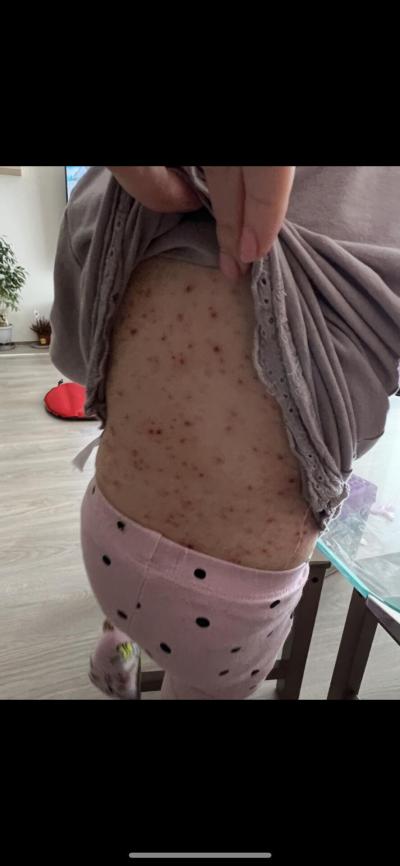 Dětské nemoci | Neštovice s pomalým průběhem?