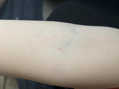 Dětské nemoci | Neštovice nebo pupínky