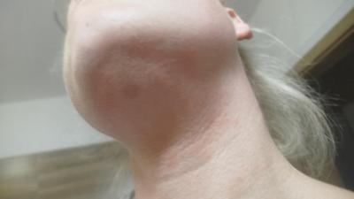 Alergie a ekzémy | Vyrážka po sirné masti
