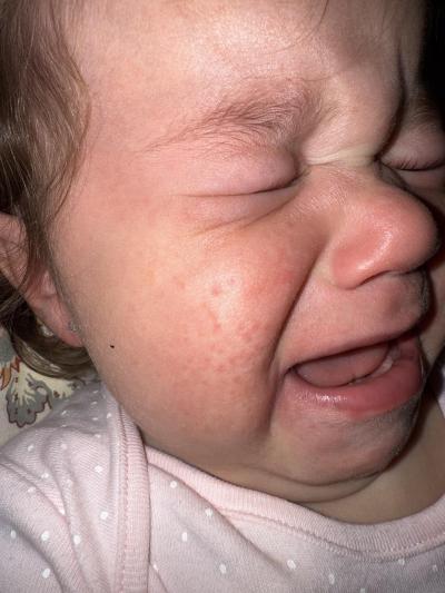 Alergie a ekzémy | Ekzém ? Dermatitida?