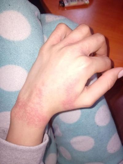 Alergie a ekzémy | Alergie na čistící prostředky