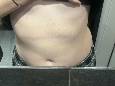 Zdravotní potíže dospělých | Pupínky na těle