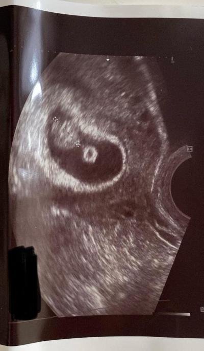 Těhotenství | Krvaceni z kasle a hematom