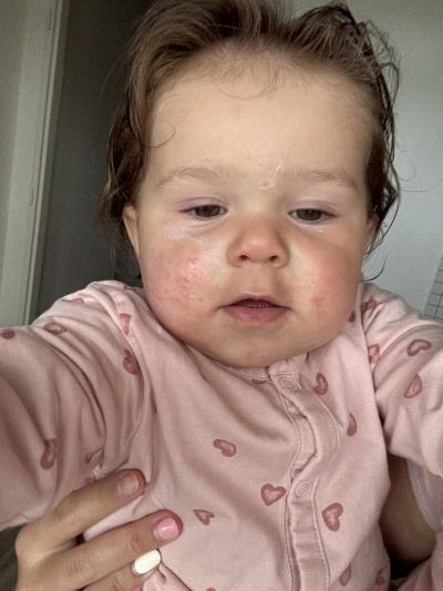 Alergie a ekzémy | Ekzém ? Dermatitida?