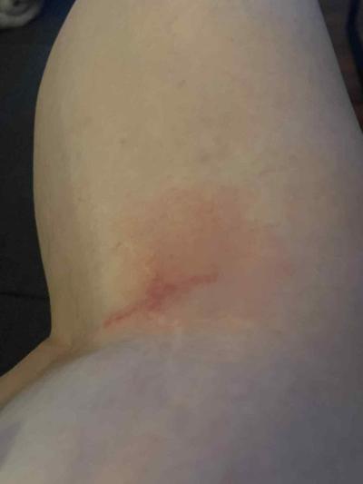 Alergie a ekzémy | Štípanec od komára, velký červený flek