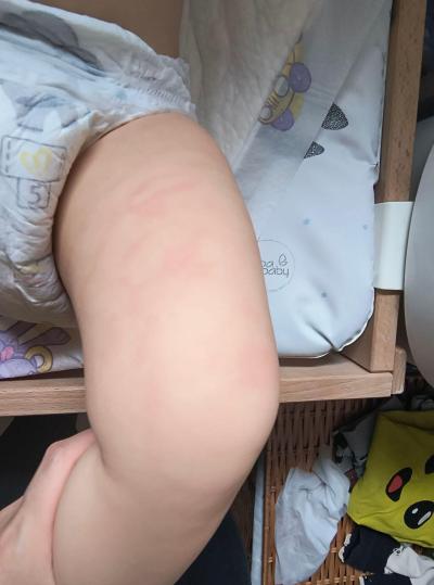 Alergie a ekzémy | Červené skvrny na kůži