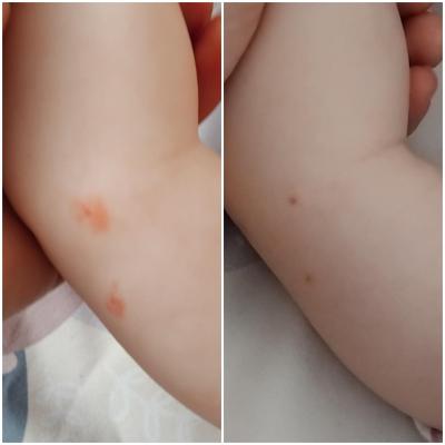 Dětské nemoci | Co je to za pupínek u 4 měsíčního dítěte