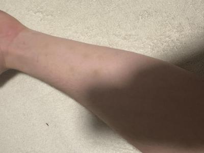 Alergie a ekzémy | Žlutohnědé fleky